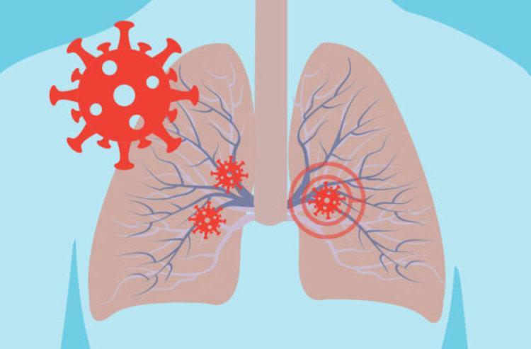تایید ارتباط نارسایی تنفسی کرونا با گروه خونی